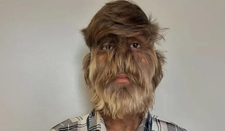 DÜNYANIN EN KILLI YÜZÜNE SAHİP GENÇ GUINNESS REKORLARINA GİRDİ!